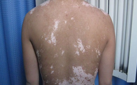 白癜風傳染嗎,白癜風是不是被傳染的,白癜風的誘發原因