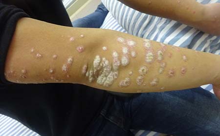 夏季怎樣治銀屑病,銀屑病夏季該怎樣治