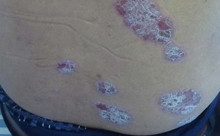 得銀屑病怎么辦,患上銀屑病怎么辦