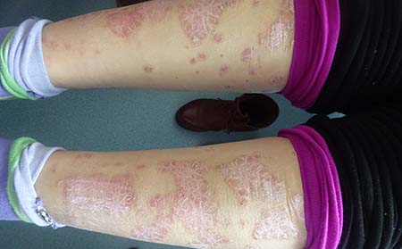 早期銀屑病治療,銀屑病早期怎樣治