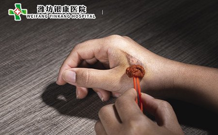 手部白癜風治療,怎樣治手部白癜風