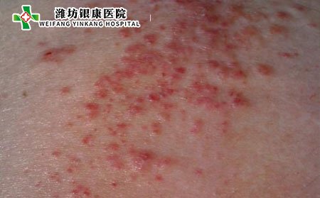 濕疹并發癥,長期得濕疹并發癥