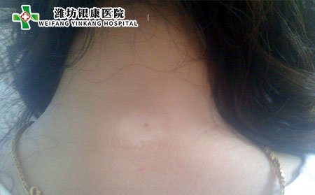 孕婦有白癜風怎么辦,孕婦白癜風怎么辦