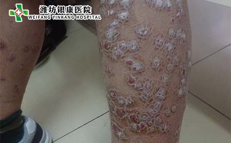 銀屑病常識,患銀屑病可怕嗎