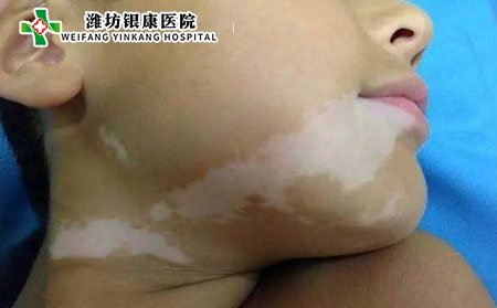 兒童白癜風癥狀,兒童白癜風什么樣