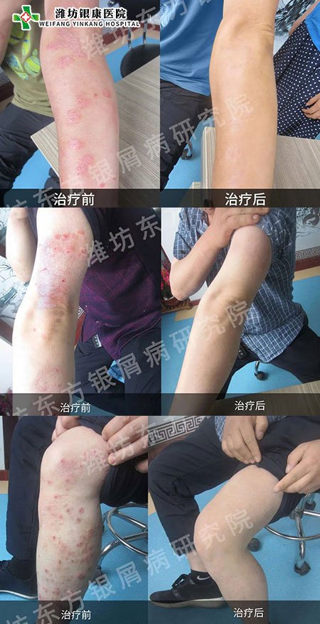 [山東]濰坊銀康醫院牛皮癬銀屑病治療康復對比圖