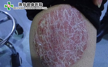 [山東]濰坊銀康醫院:成年人如何治療銀屑癬