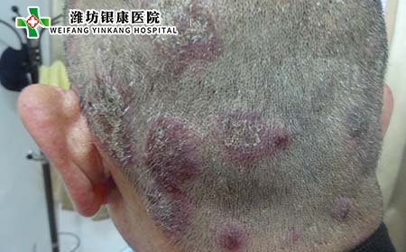 頭部銀屑病護理,頭部銀屑病怎樣洗