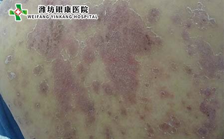 銀屑病癥狀,銀屑病有什么表現