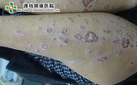 銀屑病常識(shí),銀屑病屬于什么病