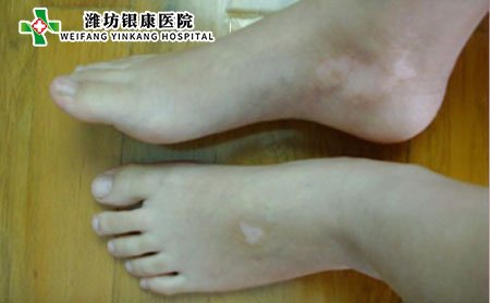 白癜風病因,為什么會得白癜風