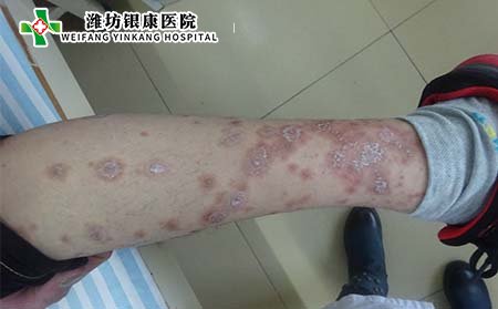 銀屑病癥狀,銀屑病什么樣