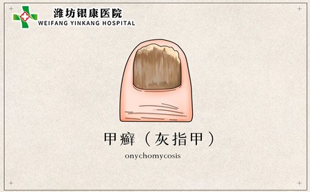 銀屑病指甲,銀屑病會得灰指甲嗎