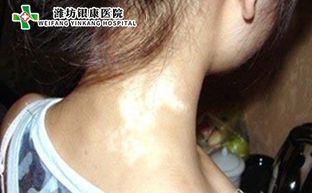 白癜風癥狀,初期白癜風的癥狀