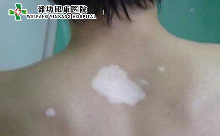 白癜風發病部位,白癜風長在哪個部位