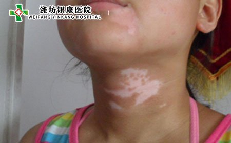 頸部白癜風治療,怎樣治頸部白癜風