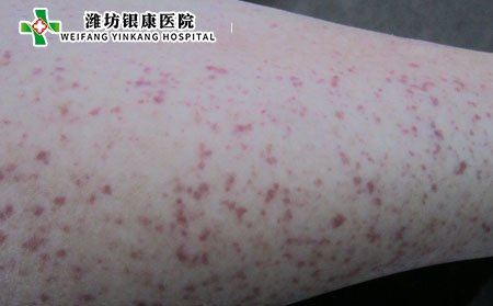 過敏性紫癜,過敏性紫癜遺傳嗎