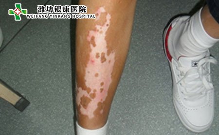 白癜風癥狀,腿部白癜風癥狀