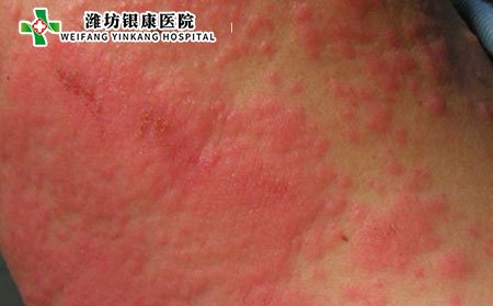 泛發性濕疹,泛發性濕疹護理