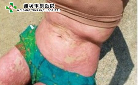 牛皮癬,兒童牛皮癬,牛皮癬癥狀,兒童牛皮癬癥狀