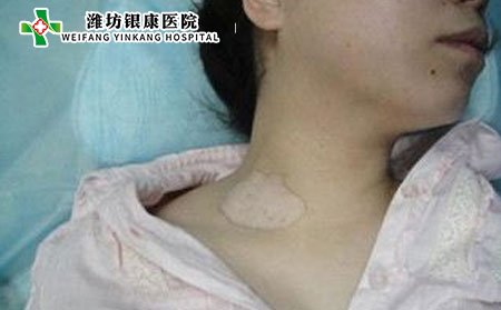 白癜風癥狀,白癜風癥狀表現