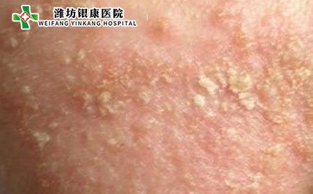 什么是特應性皮炎與濕疹的區別是什么