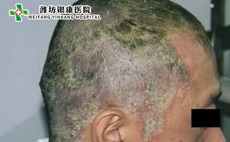 什么是頭癬類型有那些?頭癬的病因是什么?