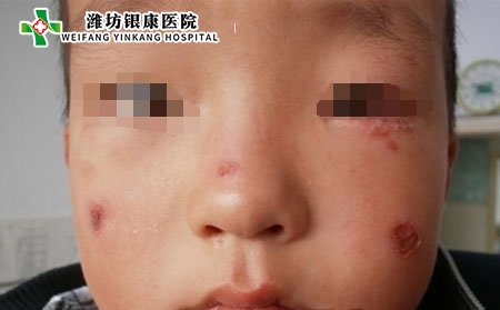 濰坊銀康醫(yī)院:中醫(yī)治療膿皰型銀屑病