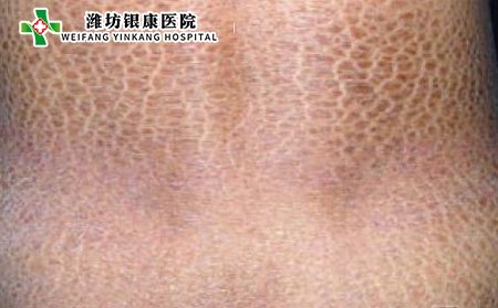 魚鱗病是什么原因引起的?能治好嗎?