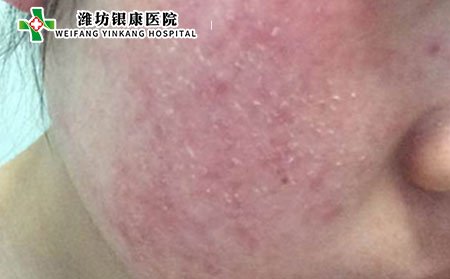 什么是皮炎性濕疹該如何治療?中醫(yī)是如何分類的?