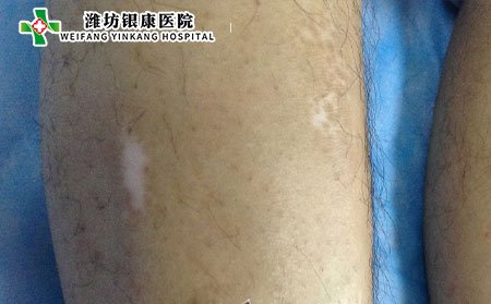 什么是繼發性白癜風?