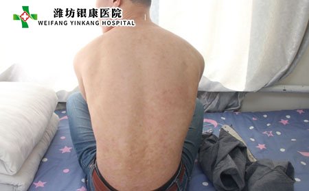 牛皮癬該如何預防?又該如何日常護理?