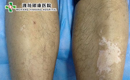 維生素C過量會(huì)引起白癜風(fēng)嗎?