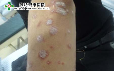 牛皮癬與副牛皮癬是一樣的嗎?