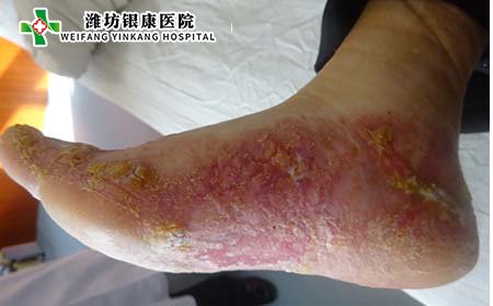 神經性牛皮癬是什么?