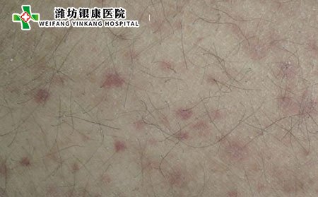 過(guò)敏性紫癜吃什么