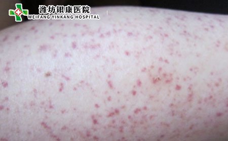 過敏性有哪幾種類型