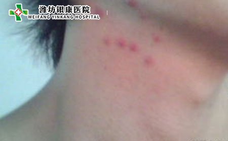 日常生活中該如何預防痤瘡?