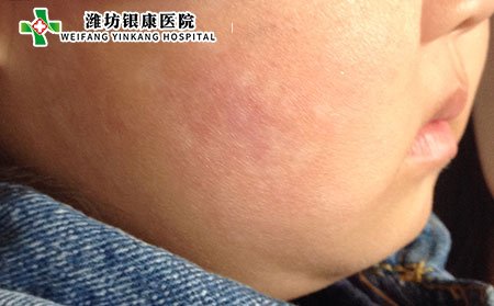 什么是血瘀型白癜風?該如何護理?