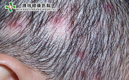 頭皮毛囊炎該如何治療?