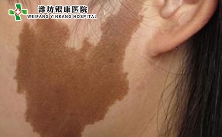 黃褐斑是怎么形成的?電腦族預防黃褐斑圖片