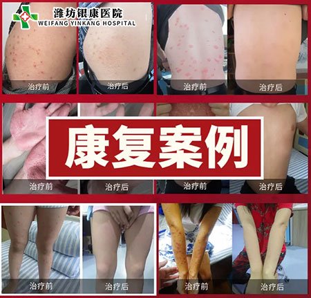 銀屑病皮膚病專家會診康復案例 銀屑病皮膚病專家會診康復案例