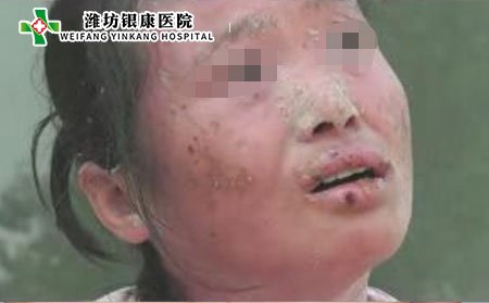 濰坊牛皮癬醫(yī)院:中藥治療牛皮癬