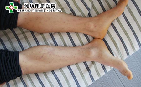 濰坊牛皮癬醫院:牛皮癬遺傳怎么辦?